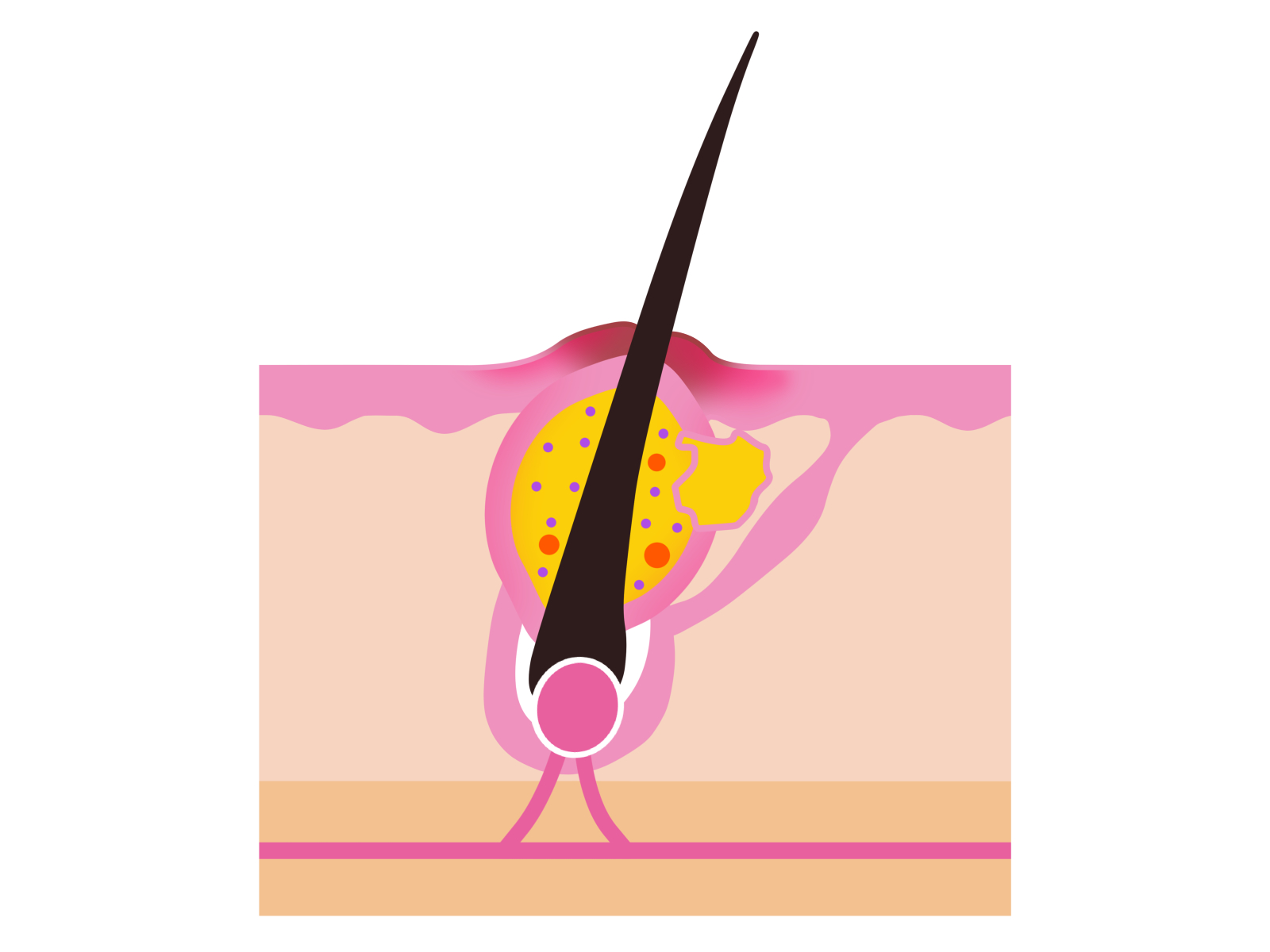 お尻のおできの症状は何ですか?